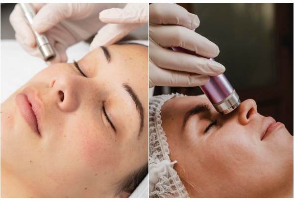 Sejas un kakla elektroporācija un dermabrāzija